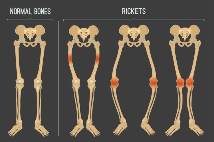 Ilustrasi perbandingan tulang normal (kiri) dan tulang pengidap rakitis kanan.