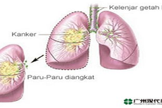 Ternyata ini Gejala Kanker Paru ?!