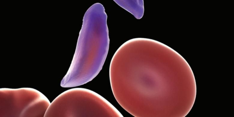 Ilustrasi sel darah merah berbentuk bulan sabit yang menyebabkan anemia. Penyebab anemia sebagian besar adalah karena kekurangan zat besi.