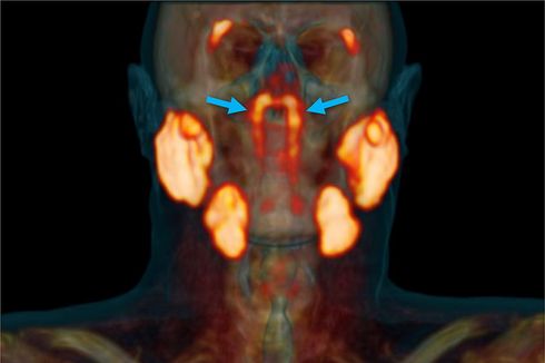 Ilmuwan Temukan Organ Baru di Tenggorokan Manusia, Apa Itu?