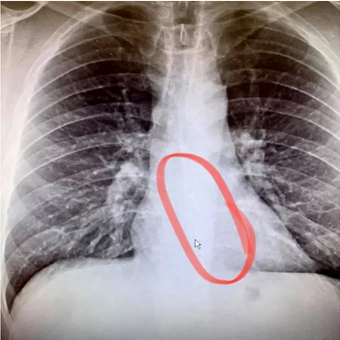 asil X-ray menunjukan adanya AirPods yang menyangkut di kerongkongan Gauthier.