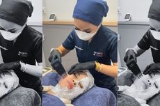 Manfaat Microneedling untuk Merangsang Kolagen dan Bikin Awet Muda