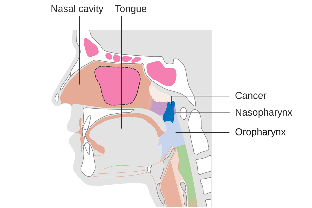 Ilustrasi kanker nasofaring