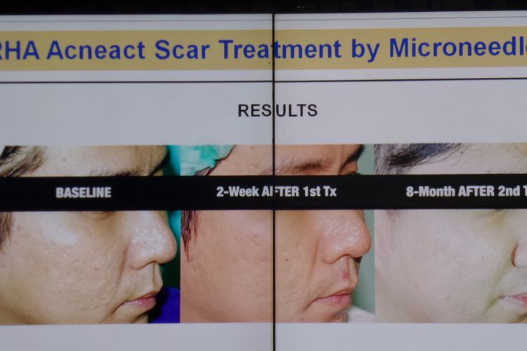 Erha Acneact Scar Treatment by Microneedle RF.