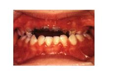 Gigi Atas Anak Tinggal Sedikit Akibat Karies, Bolehkah Dicabut?  
