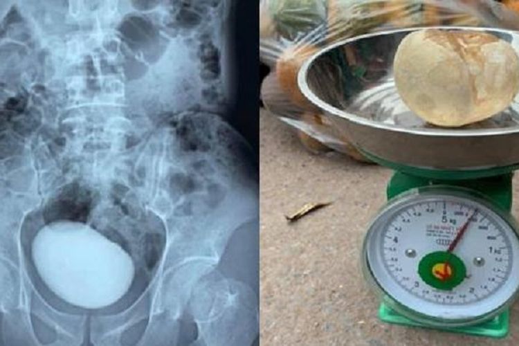 Foto yang viral di media sosial Vietnam memerlihatkan batu kandung kemih yang disebut seberat 400 gram dikeluarkan dari perempuan 34 tahun.