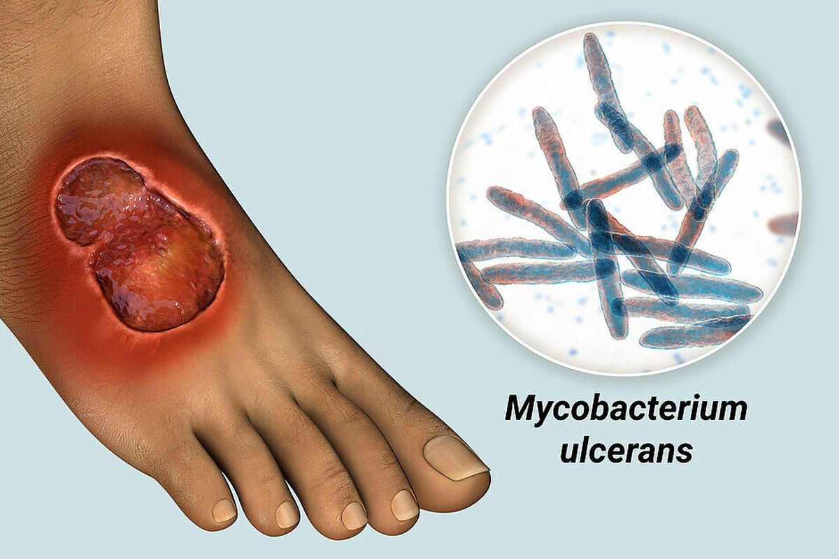 Ilustrasi borok Buruli ulcer akibat bakteri Mycobacterium ulcerans