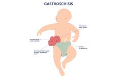 Gastroschisis