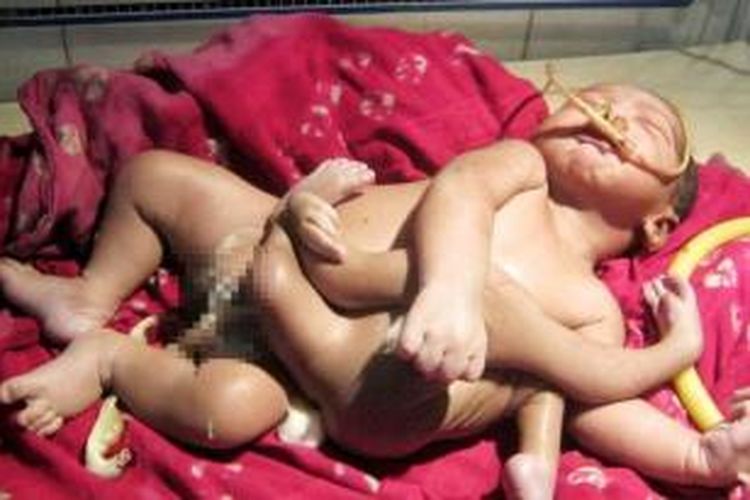 Seorang bayi berkaki dan bertangan empat lahir di kota Bariapur, negara bagian Bengal Barat, India. Kelahiran bayi ini menghebohkan warga setempat yang menganggap bayi itu sebagai titisan salah seorang dewa.