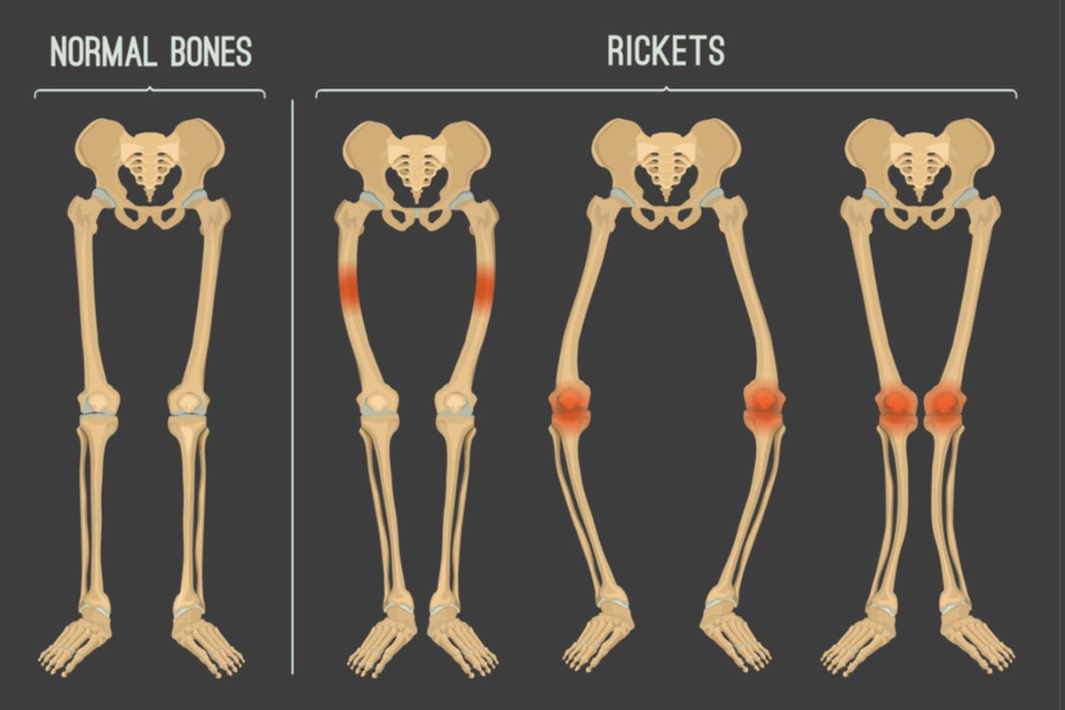 Ilustrasi rakitis