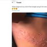 Ramai soal Bentol Berair di Area Punggung, Benarkah Gejala Herpes Zoster? 