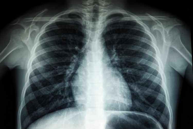 Program TB Masih Sulit Jangkau Disabilitas dan Daerah Terpencil