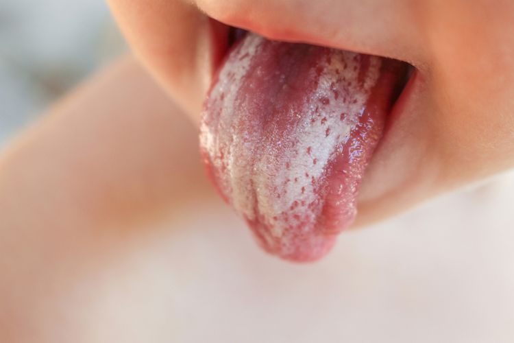 Ilustrasi lidah putih bayi