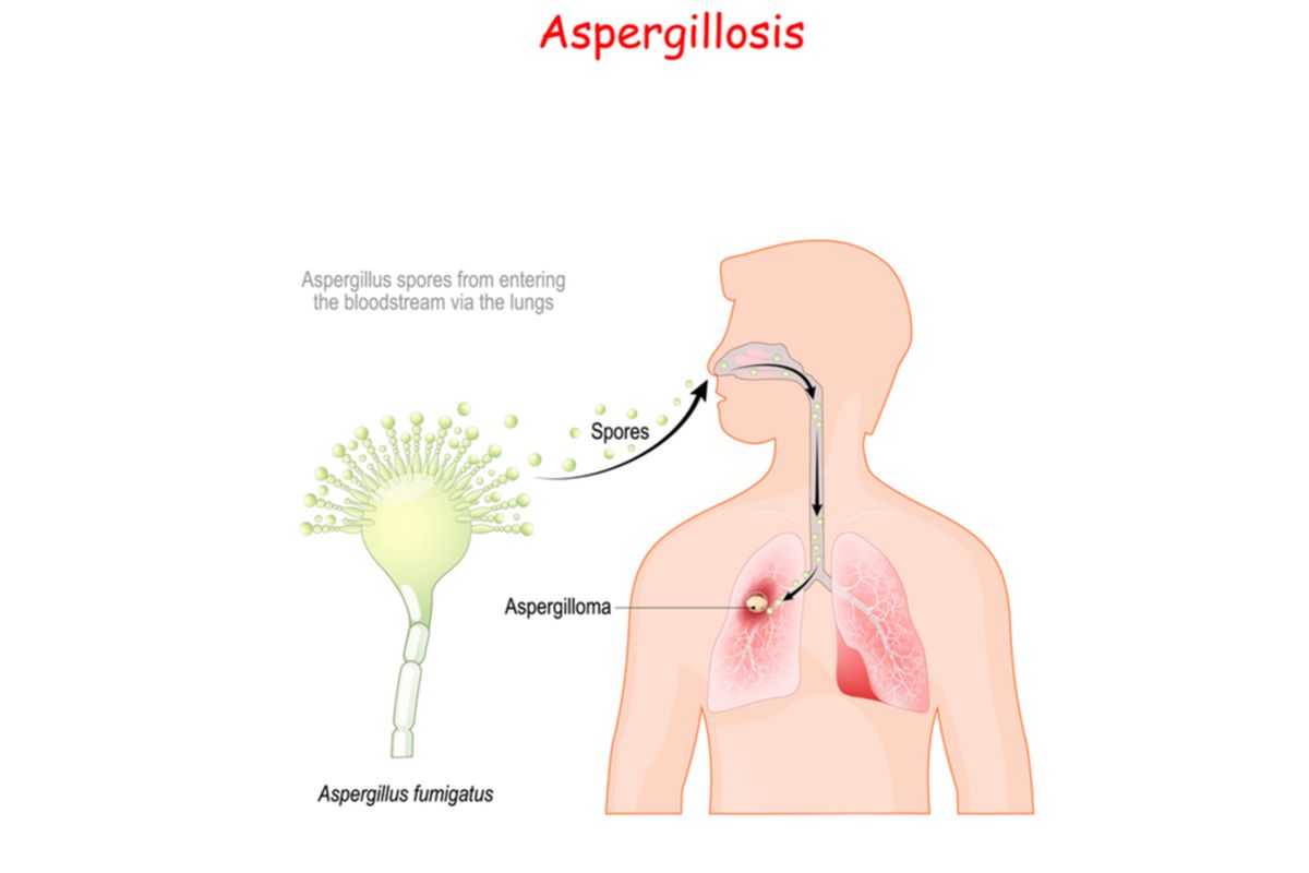 Ilustrasi Aspergillosis