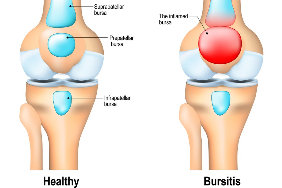 Ilustrasi Bursitis