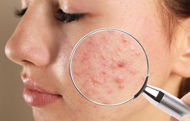 Ilustrasi bekas jerawat. Mengapa bekas jerawat susah hilang. Kenali bedanya cara menghilangkan bekas jerawat hitam dan merah yang tepat. 