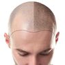 LG Ciptakan Helm Penumbuh Rambut untuk Atasi Kebotakan