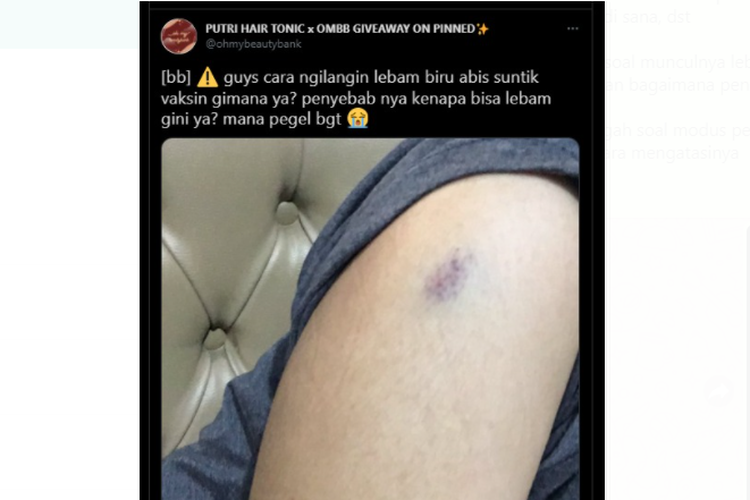 Muncul Memar Di Lengan Setelah Vaksinasi Apa Penyebabnya Halaman All Kompas Com