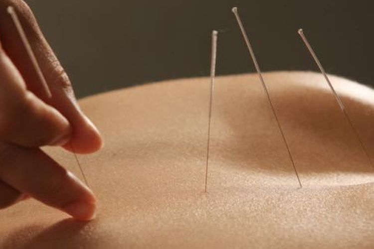 Ilustrasi akupuntur