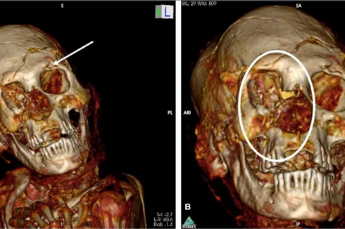 Misteri Kematian Mumi Berusia 1.000 Tahun Terungkap lewat CT Scan
