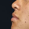 Hyaluronic Acid dan Vitamin E untuk Cegah Bintik Hitam di Wajah