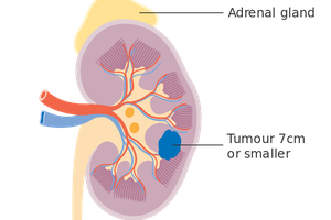 Gejala Kanker Ginjal: Sering Tak Terlihat di Awal, Ini Tanda yang Perlu Diwaspadai