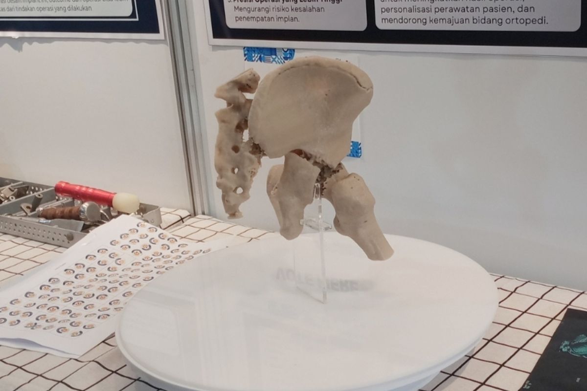 Dokter di Malang Dorong Penerapan Teknologi 3D Printing untuk Operasi Patah Tulang