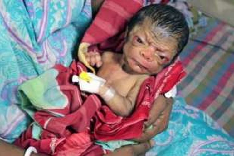 Seorang bayi yang dilahirkan di Banglades menderita sebuah sindrom langka yang membuatnya nampak seperti orang lanjut usia.