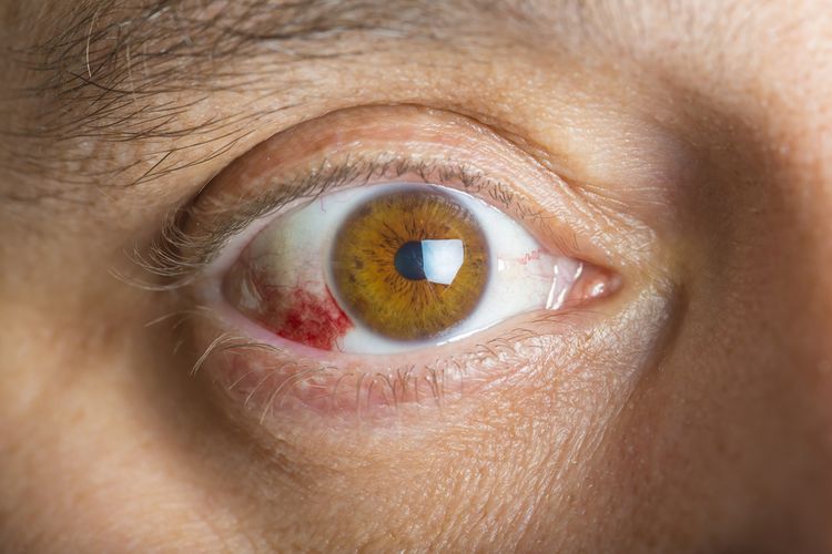 Ilustrasi mata berdarah, penyebab mata berdarah, kenapa mata berdarah, cara mengatasi mata berdarah. 