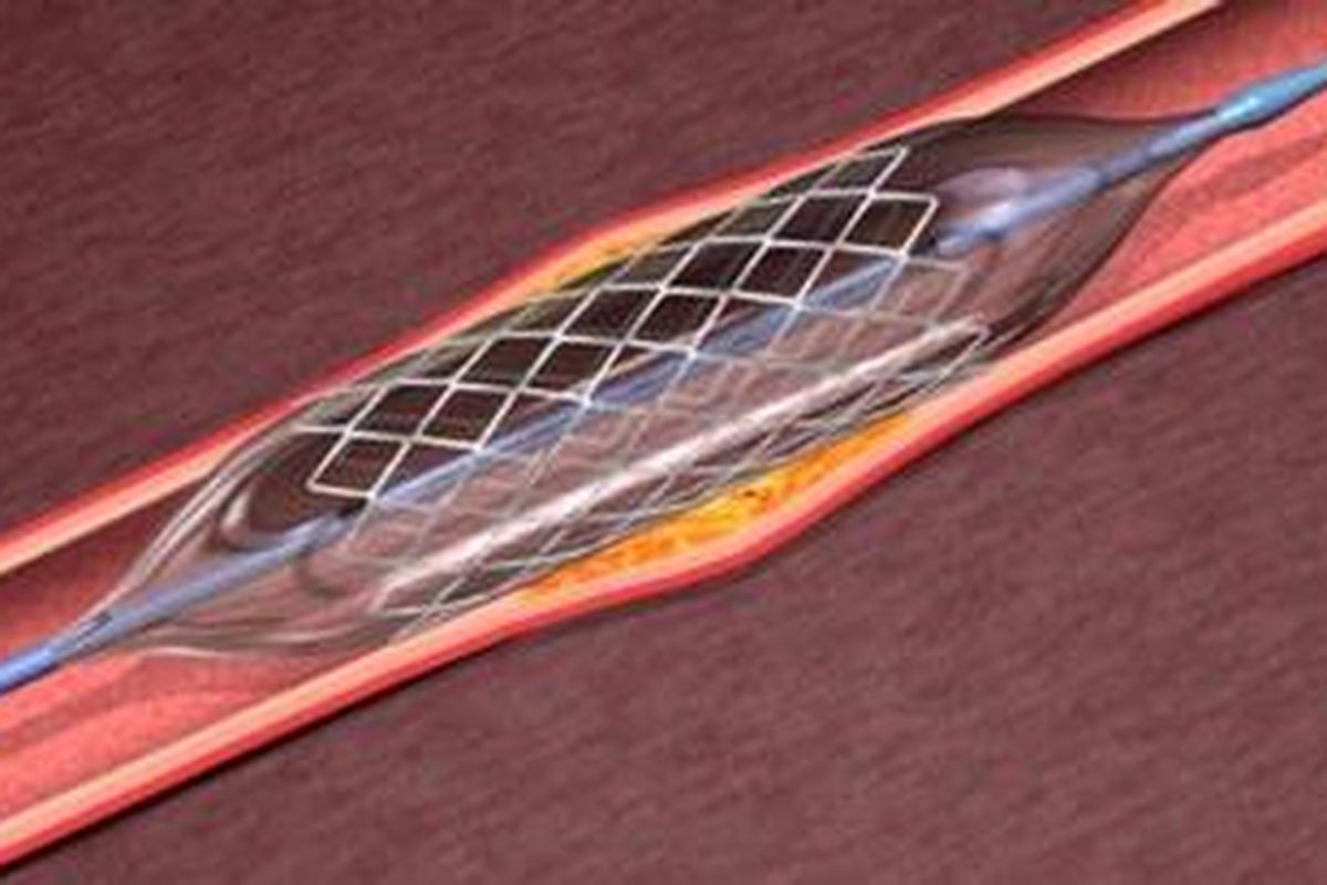 Stent dipasang pada arteri untuk mencegah terjadinya penyempitan kembali yang bisa memicu serangan jantung atau stroke.