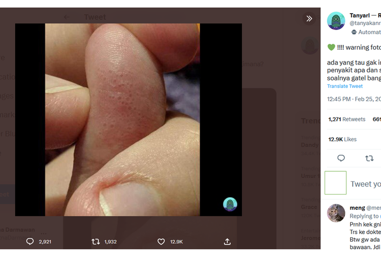 Viral, Foto Telapak Jari Terlihat Berlubang, Penyakit Apa Itu?