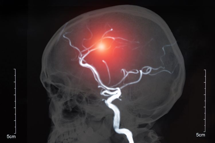 Ilustrasi aneurisma otak. Aneurisma otak biasanya tidak menimbulkan gejala ketika masih utuh. Ketika sudah pecah akan menyebabkan rasa sakit kepala yang luar biasa. 