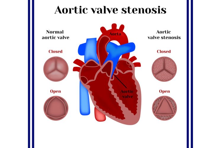 Ilustrasi stenosis aorta