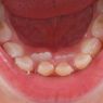 Akademisi Unair: Ini Cara Merawat Gigi bagi Anak Berkebutuhan Khusus