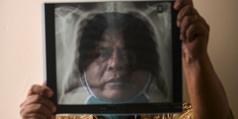 Alben Sitohang (68) menunjukkan hasil rontgen paru-paru miliknya di Jakarta. Wiraswasta itu menjalani isolasi di RS darurat Wisma Atlet selama 22 hari dan dinyatakan negatif pada 19 April 2020.