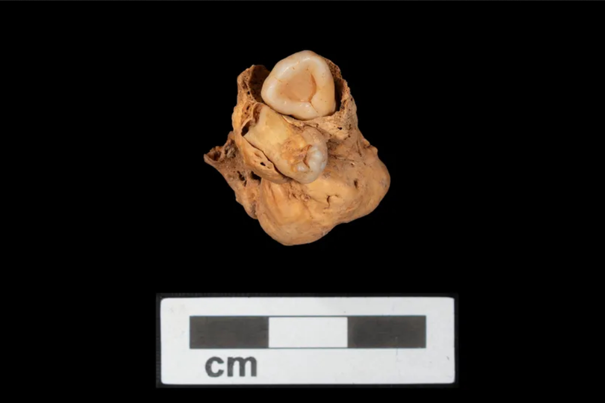 Tumor langka yang ditemukan di pemakaman Mesir kuno 