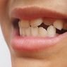 11 Penyebab Gigi Tidak Rata dan Cara Mengatasinya