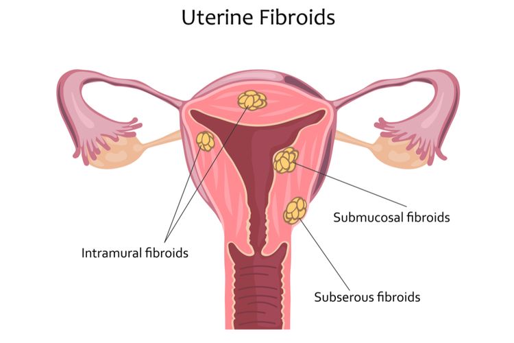 Ilustrasi fibroid rahim. Fibroid rahim adalah pertumbuhan massa yang bukan kanker dan sering muncul pada usia produktif wanita untuk hamil dan melahirkan. 