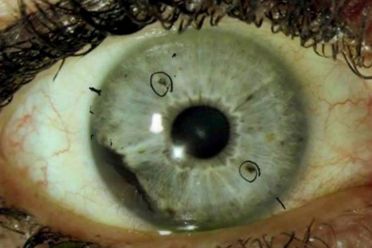 Bintik-bintik yang dilingkari di mata ini adalah melanoma okular.