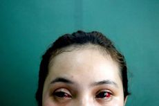 Tragedi Kanjuruhan: Mata Merah Keviana Baru Bisa Sembuh 1-2 Bulan