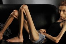 Perubahan Luar Biasa Wanita Pengidap Anoreksia Lawan Penyakitnya