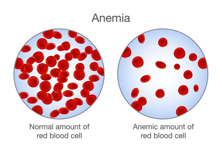 Ilustrasi sel darah merah normal dan anemia atau kekurangan sel darah merah. Penggunaan manjakani berlebihan dapat menyebabkan anemia.