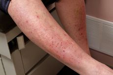 Dermatitis Herpetiformis