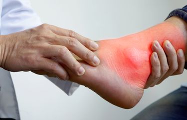 Kaki penderita asam urat mengalami peradangan.