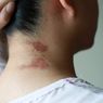 5 Gejala Awal Digigit Tomcat, Beda dari Gejala Herpes Kulit