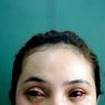 Tragedi Kanjuruhan: Mata Merah Keviana Baru Bisa Sembuh 1-2 Bulan