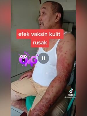 Potongan gambar dari video Efek Vaksin Kulit Rusak yang viral di TikTok.