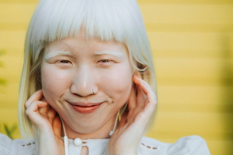 Penyebab Genetik Albino: Mengapa Kulit dan Rambut Mereka Berbeda?