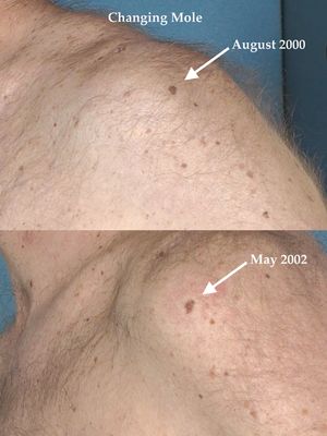 Tahi lalat yang berkembang atau mengalami perubahan bisa menjadi tanda melanoma.