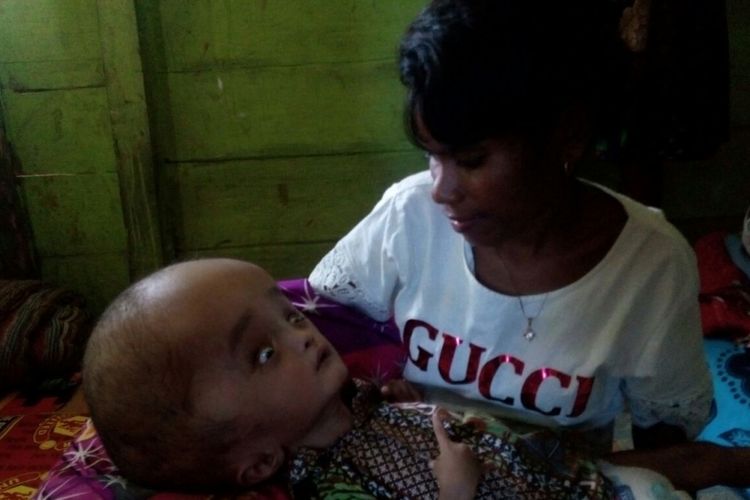 Yanti Gutanjala (22) menggendong bayinya Hofni Indro Gutanjala yang menderita  hidrosefalus di rumahnya di Kelurahan Siwalima,  Dobo,  Kabipaten Kepulauan Aru,  Maluku,  Selasa (6/2/2018) lalu.